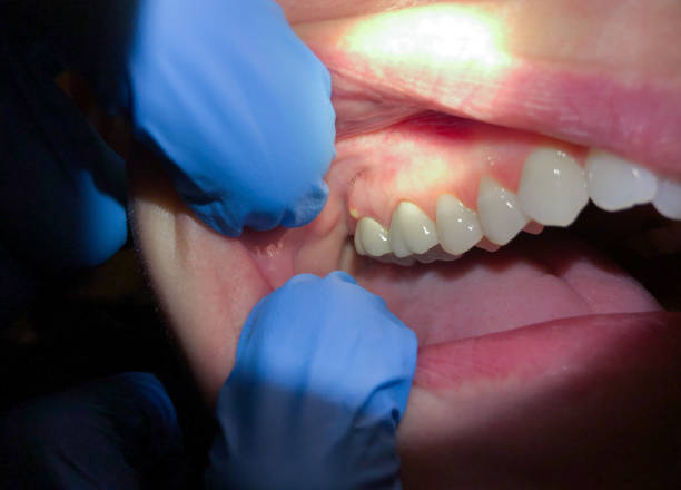 Best Emergency Dentist for Lost Fillings or Crowns in Opa Locka, FL